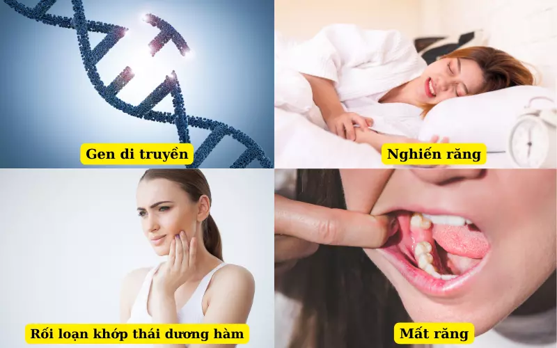 Nguyên nhân dẫn đến lệch hàm