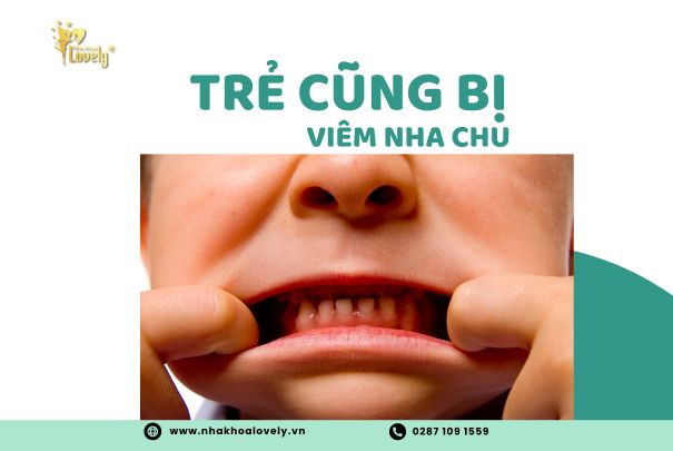 Trẻ cũng bị Viêm nha chu