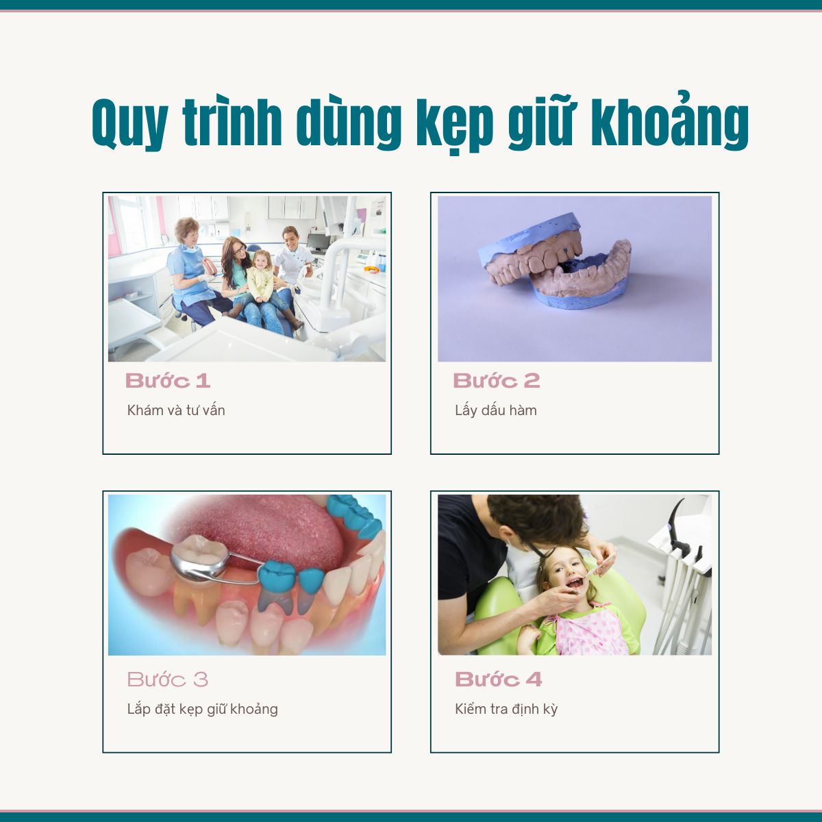 Quy trình sử dụng kẹp giữ khoảng