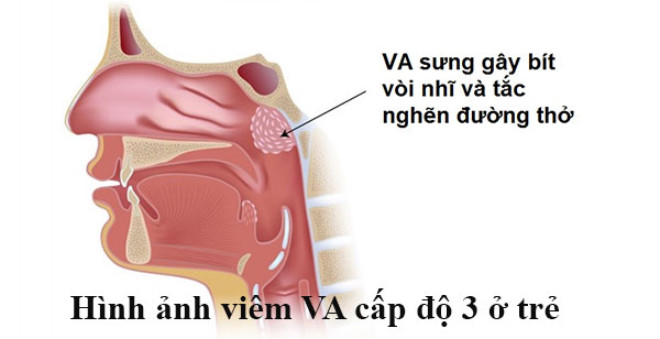 Hình ảnh Viêm VA cấp độ 3 ở trẻ