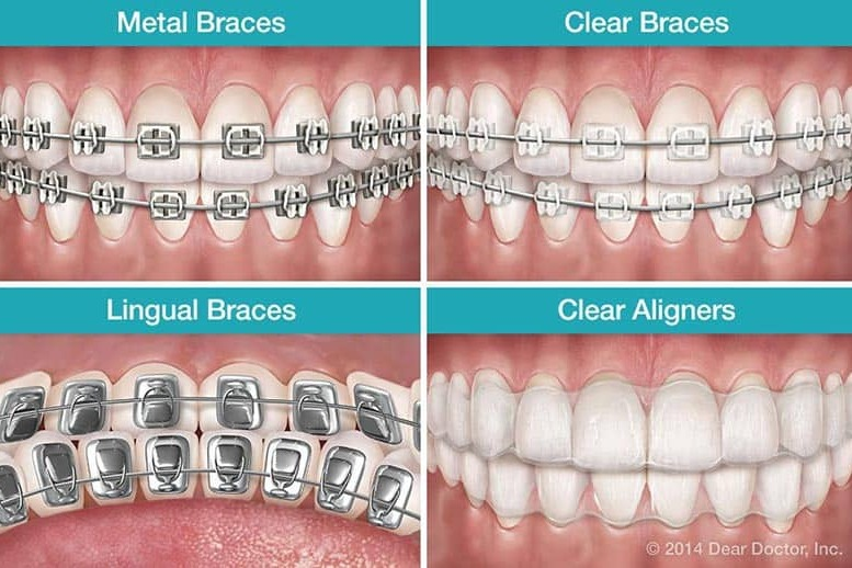 Các loại mắc cài phổ biến hiện nay