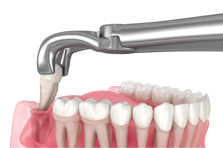 Răng khôn bị sâu: Trám hay nhổ?