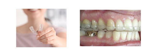 chi phí điều trị TMJ trọn gói gồm máng nhai