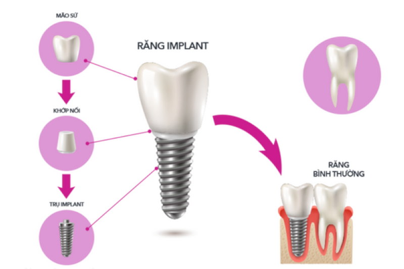 Cấu trúc độc lập của implant phù hợp cho người mất răng chịu lực và muốn bảo tồn răng thật.