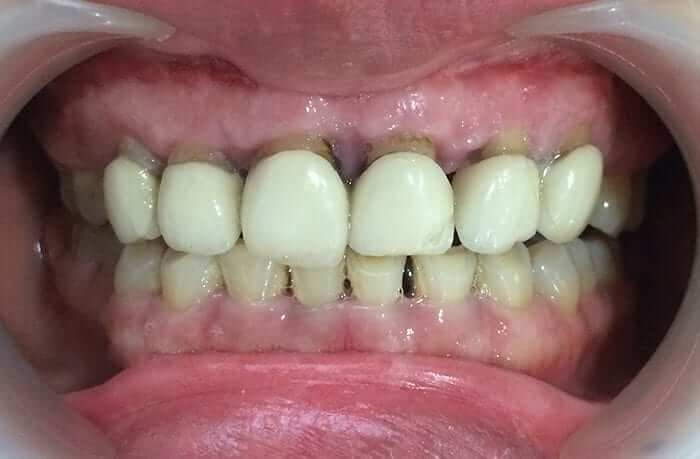 Tình trạng hở viền răng sứ gây tích tụ mảng bám và hôi miệng.