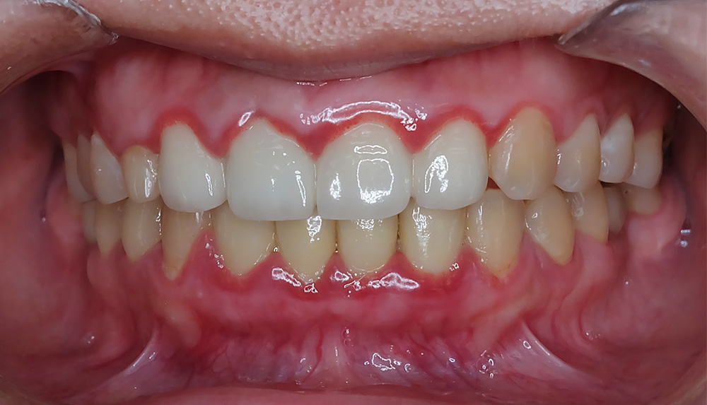 Viêm nướu sưng đỏ giải thích tại sao bọc răng sứ xong bị viêm lợi.