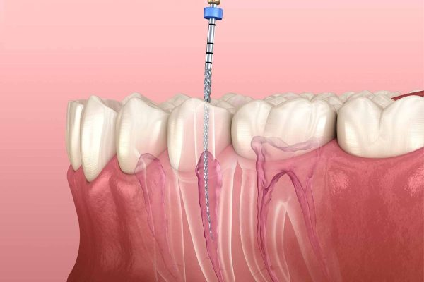 Tủy răng bị kích thích lý giải răng sứ bị ê buốt khi ăn đồ nóng lạnh.