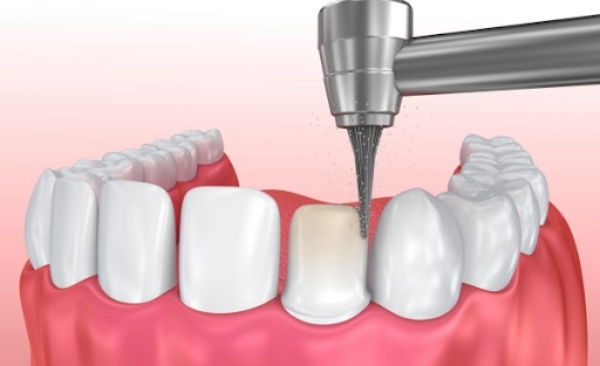 Tỷ lệ mài răng chuẩn y khoa giải đáp mài răng để bọc sứ có làm hỏng răng thật sau này không.