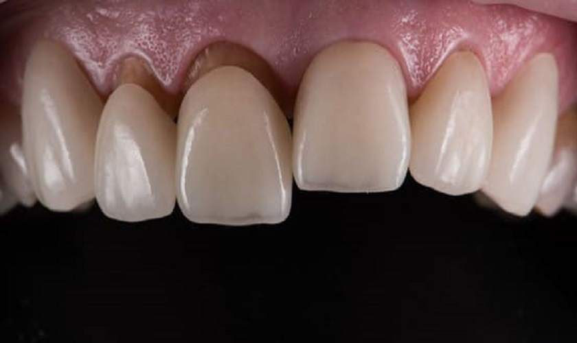Mão răng bị hở giải thích hiện tượng răng sứ bị lỏng lung lay hoặc rơi ra ngoài.