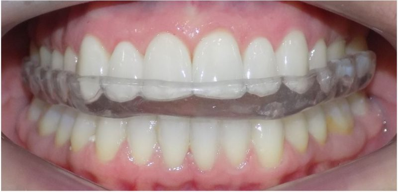 Thiết kế máng chuẩn xác giải đáp đeo máng nhai khi ngủ có gây khó thở không.
