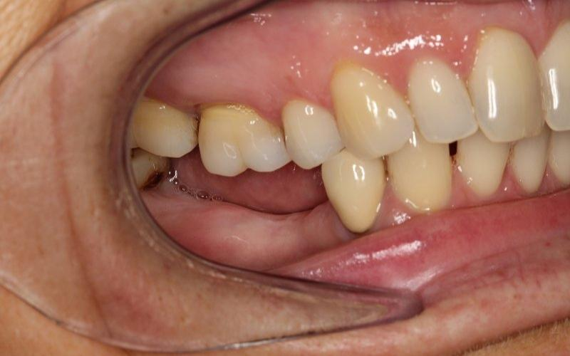 Các răng toàn hàm bị xô lệch và tiêu xương sau khi mất răng lâu năm.