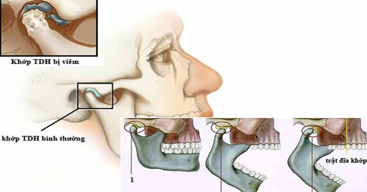 Hạn chế mở miệng rộng giải đáp có nên há miệng to khi đang bị đau khớp thái dương hàm.