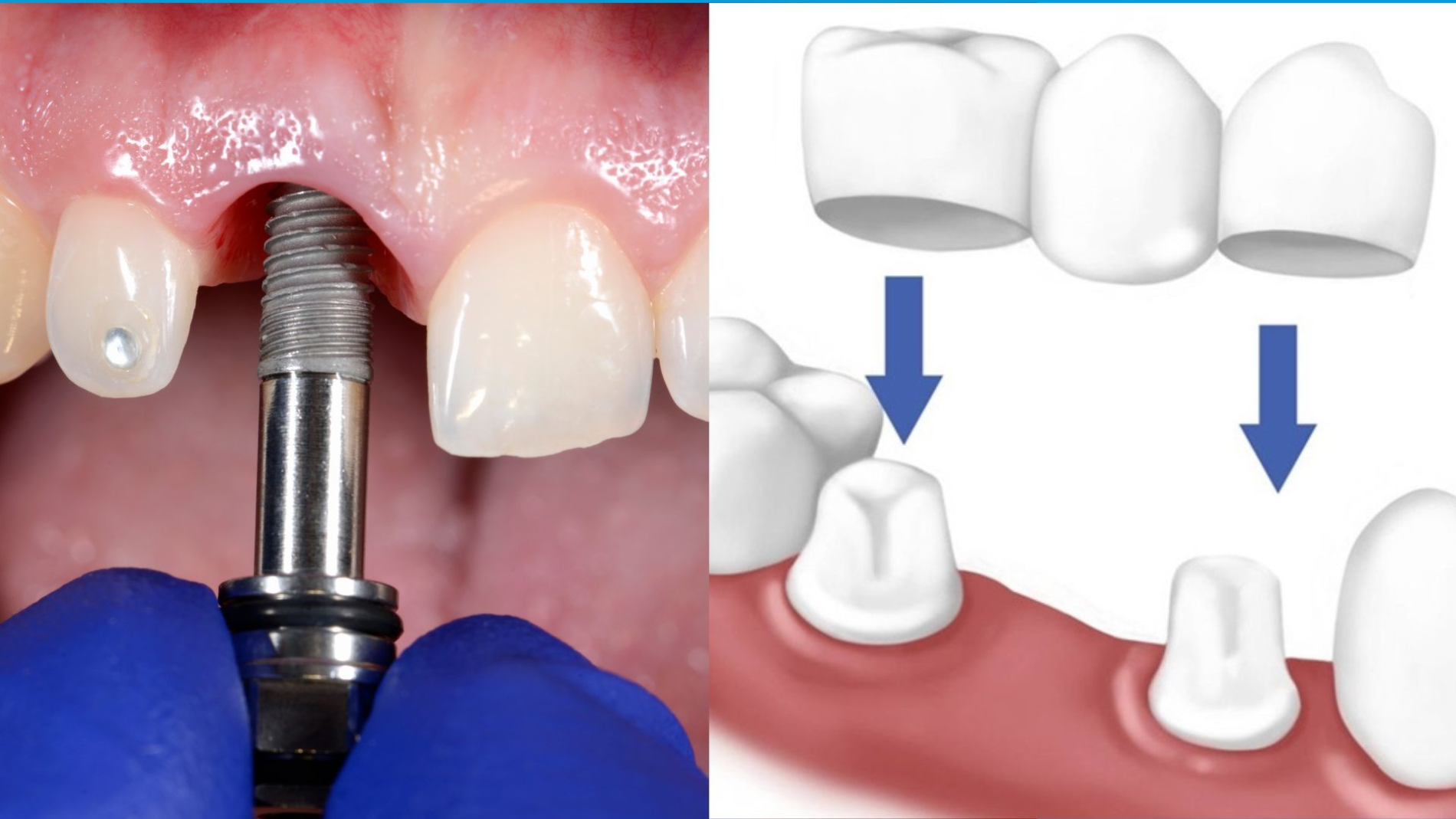 So sánh cấu trúc cầu răng sứ và implant sau thời gian dài sử dụng.