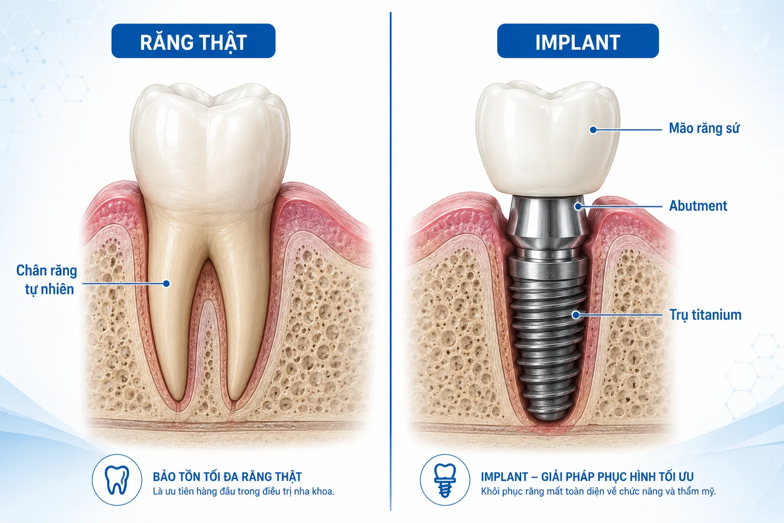 Trụ implant cấu trúc độc lập không cần mài răng thật kế cận.