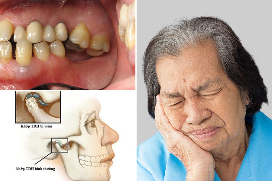 Trồng răng implant giúp điều trị mất răng gây đau khớp thái dương hàm.