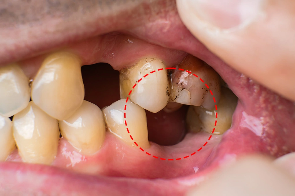 Tình trạng tiêu xương và răng xô lệch do trồng implant quá muộn.
