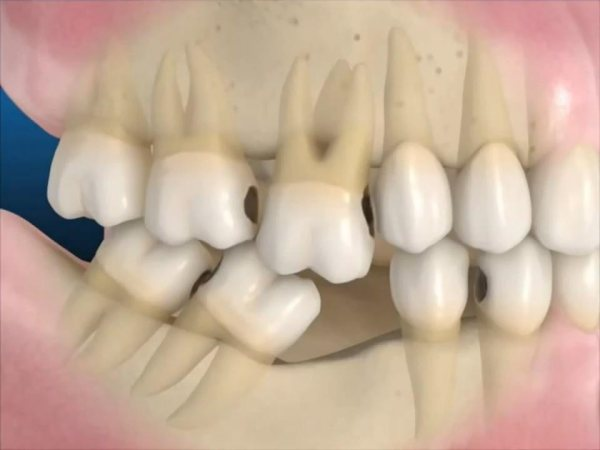 Tình trạng xô lệch răng cảnh báo cần trồng lại răng đã mất ngay.